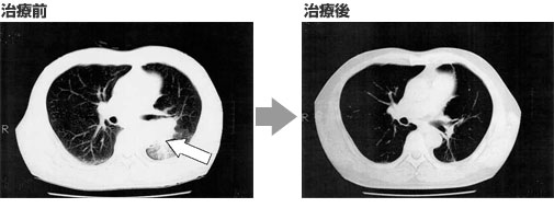 肺癌(肺がん)⇒肝臓へ転移(肝臓がん) 治療の経過