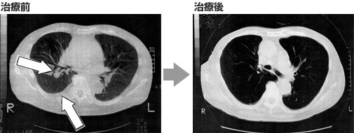 大腸癌(大腸がん) 治療の経過