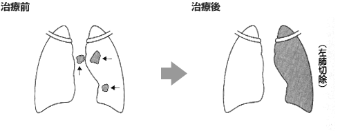 肺癌(肺がん) 治療の経過